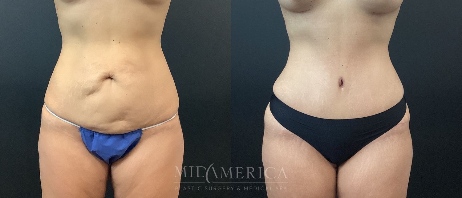 Tummy Tuck Before & After