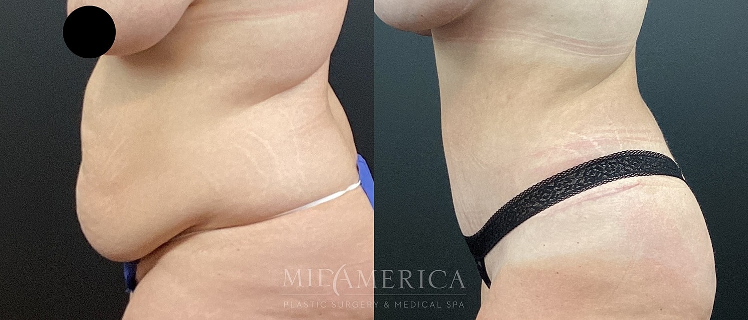 Before and after body contouring results.