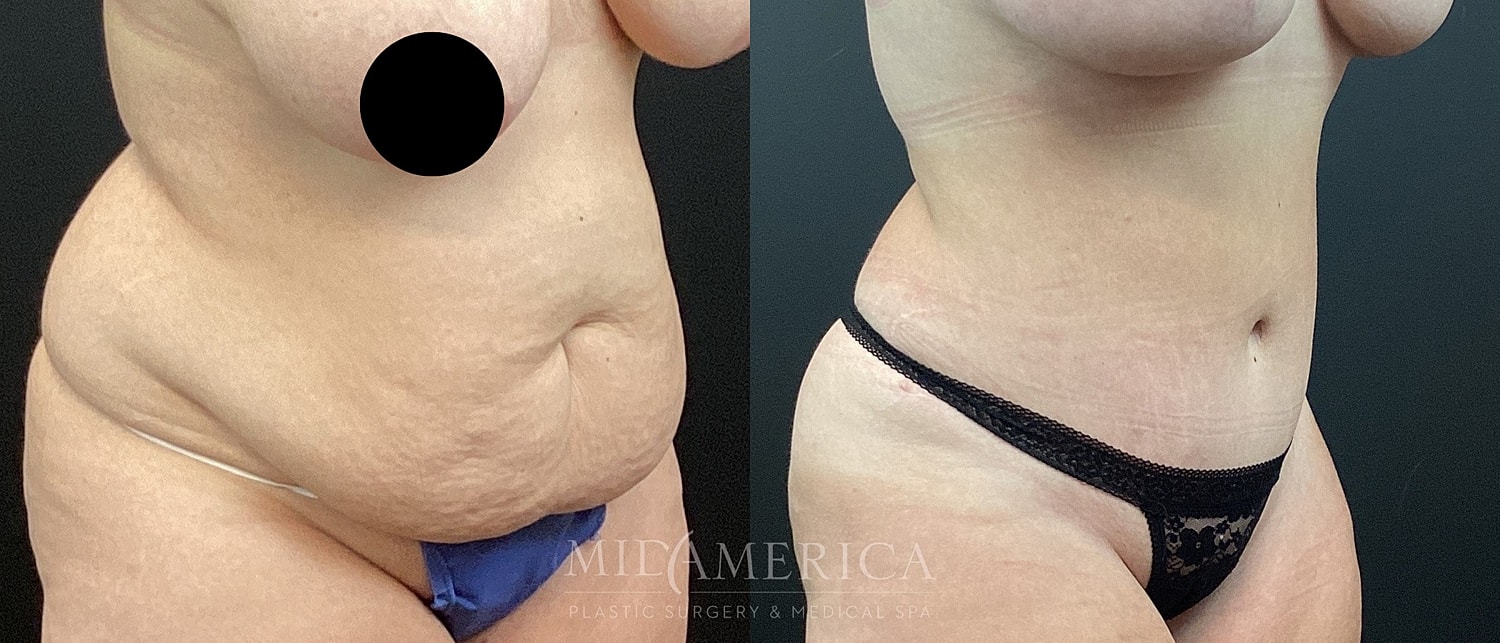 Before and after body contouring procedure comparison.