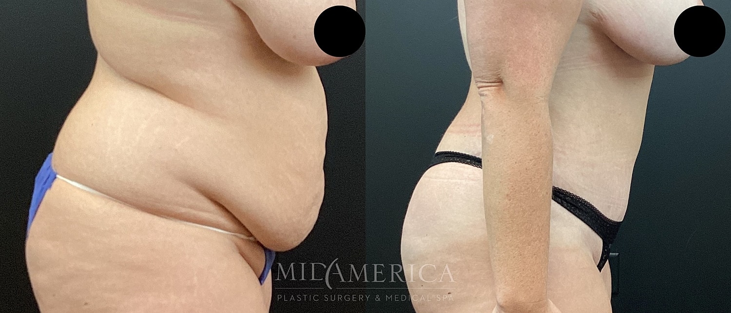 Before and after body transformation comparison photo.