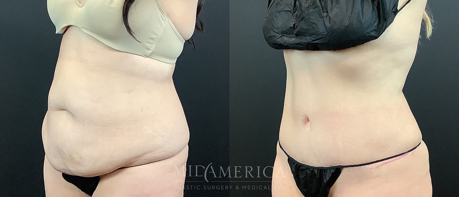 Before and after body contouring transformation.