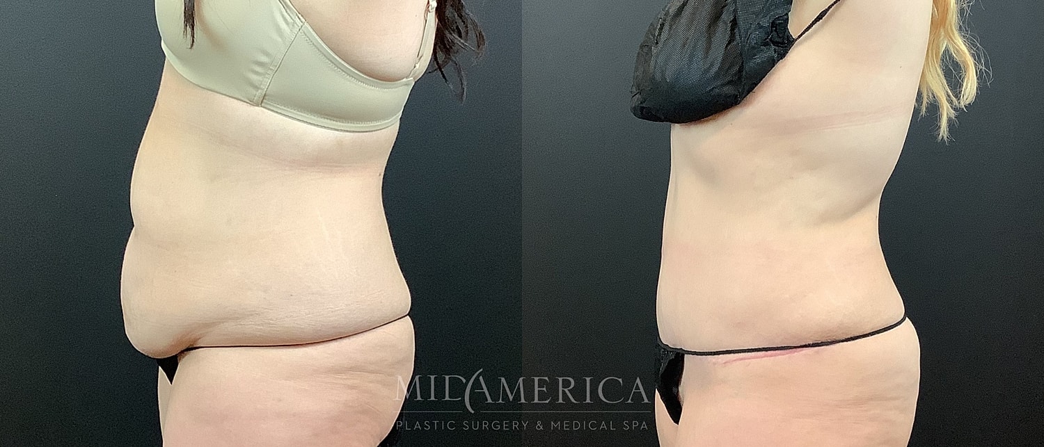 Before and after body contouring images side by side