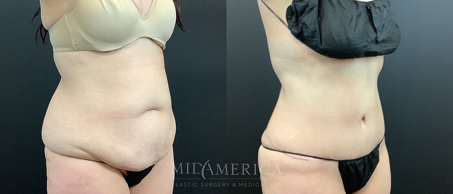 Before and after body contouring results