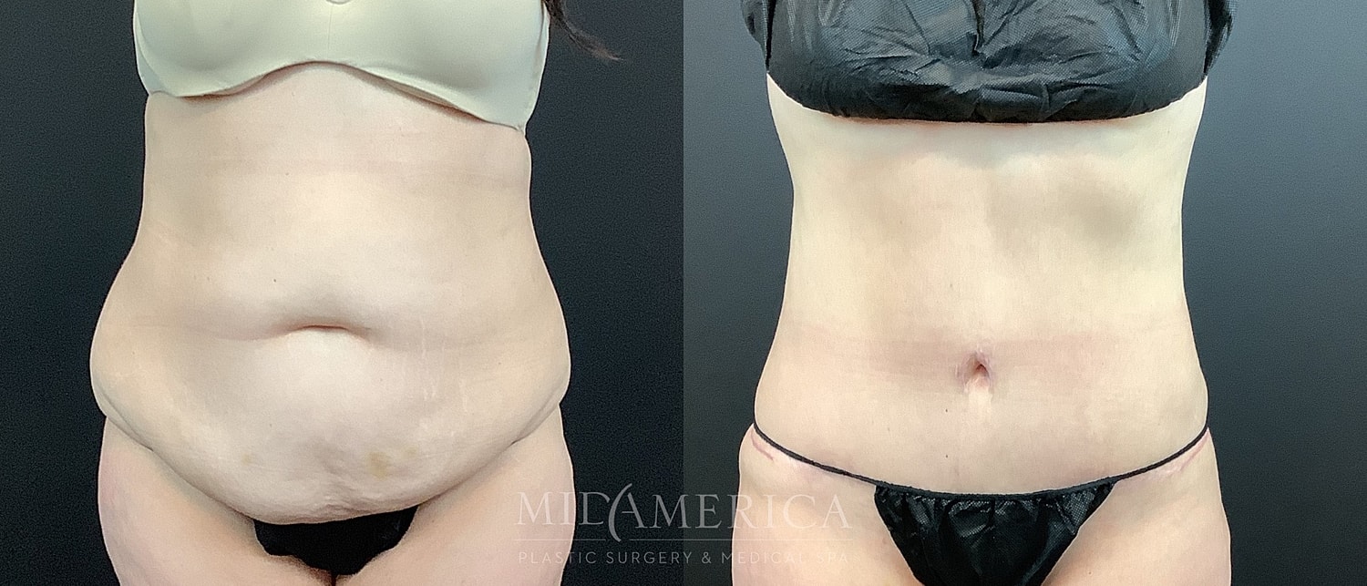 Before and after body contouring results.