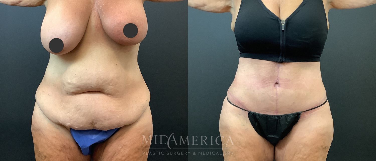 Tummy Tuck Before & After