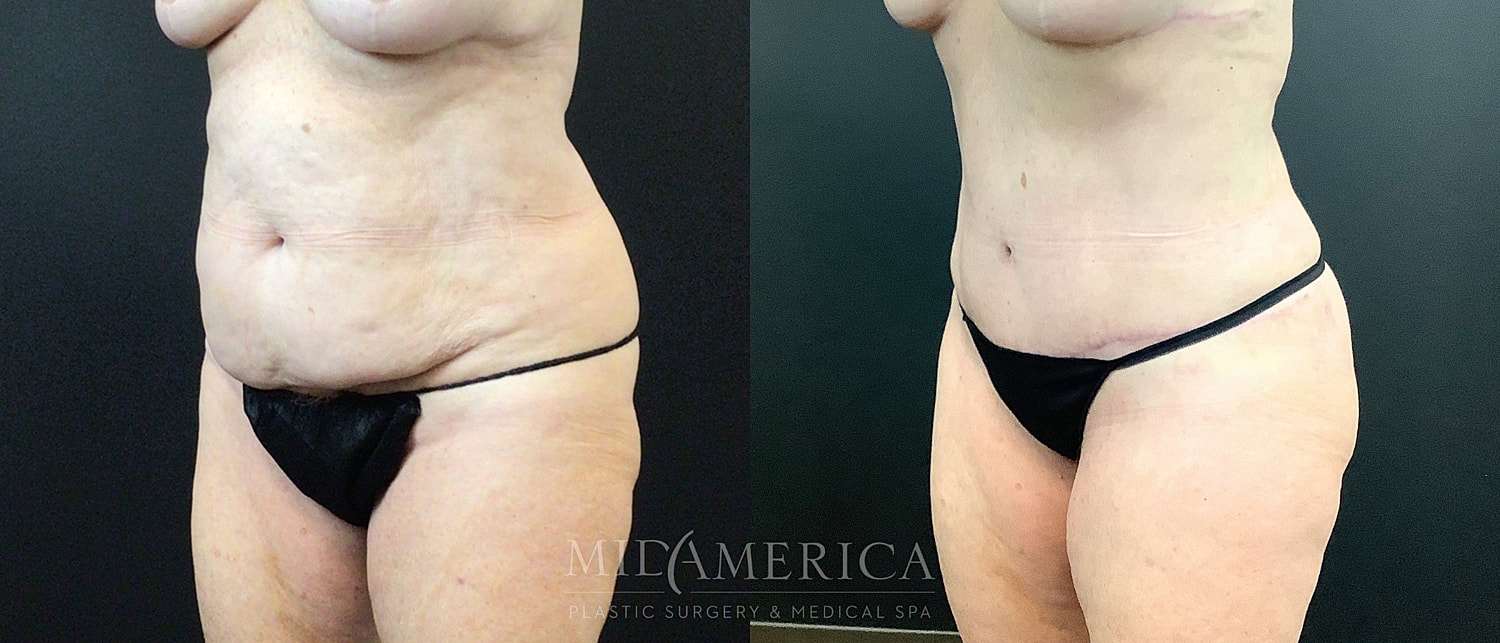 Before and after body contouring procedure photos.