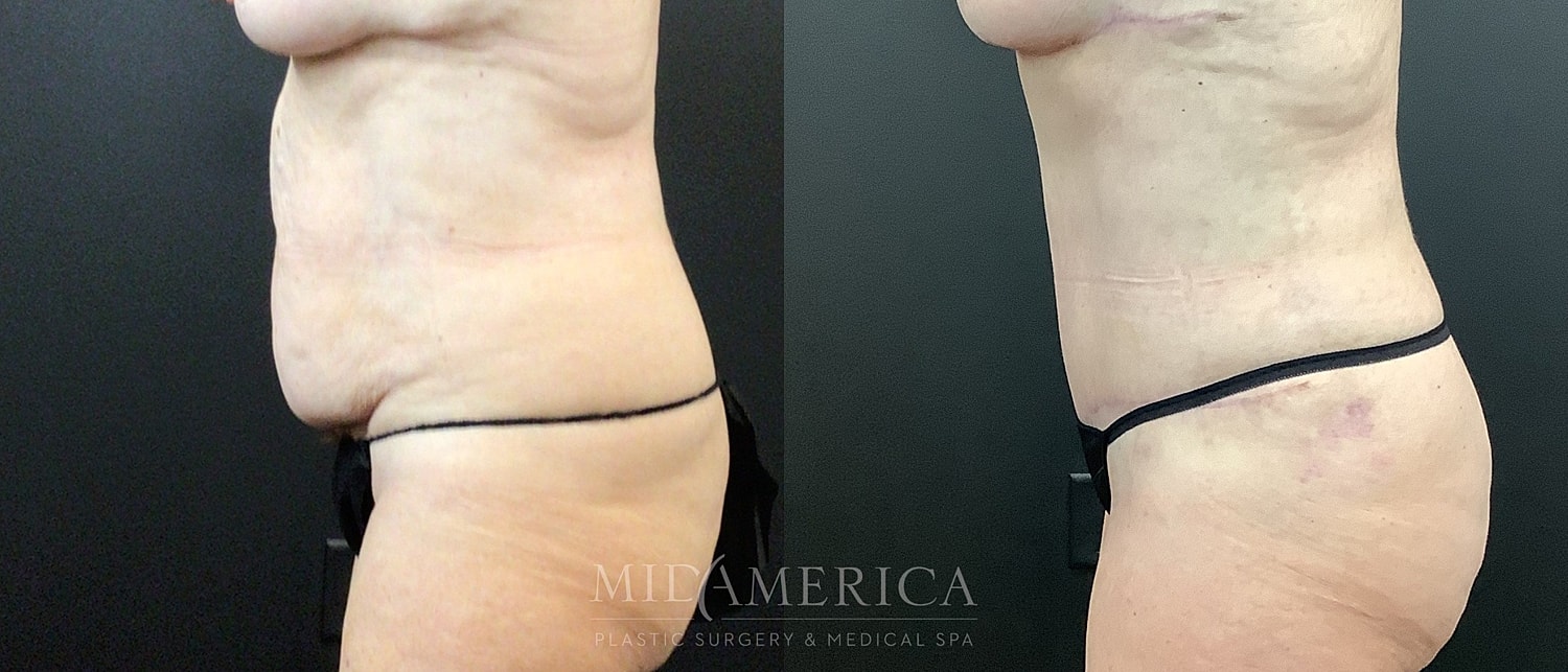 Body contouring before and after comparison image.