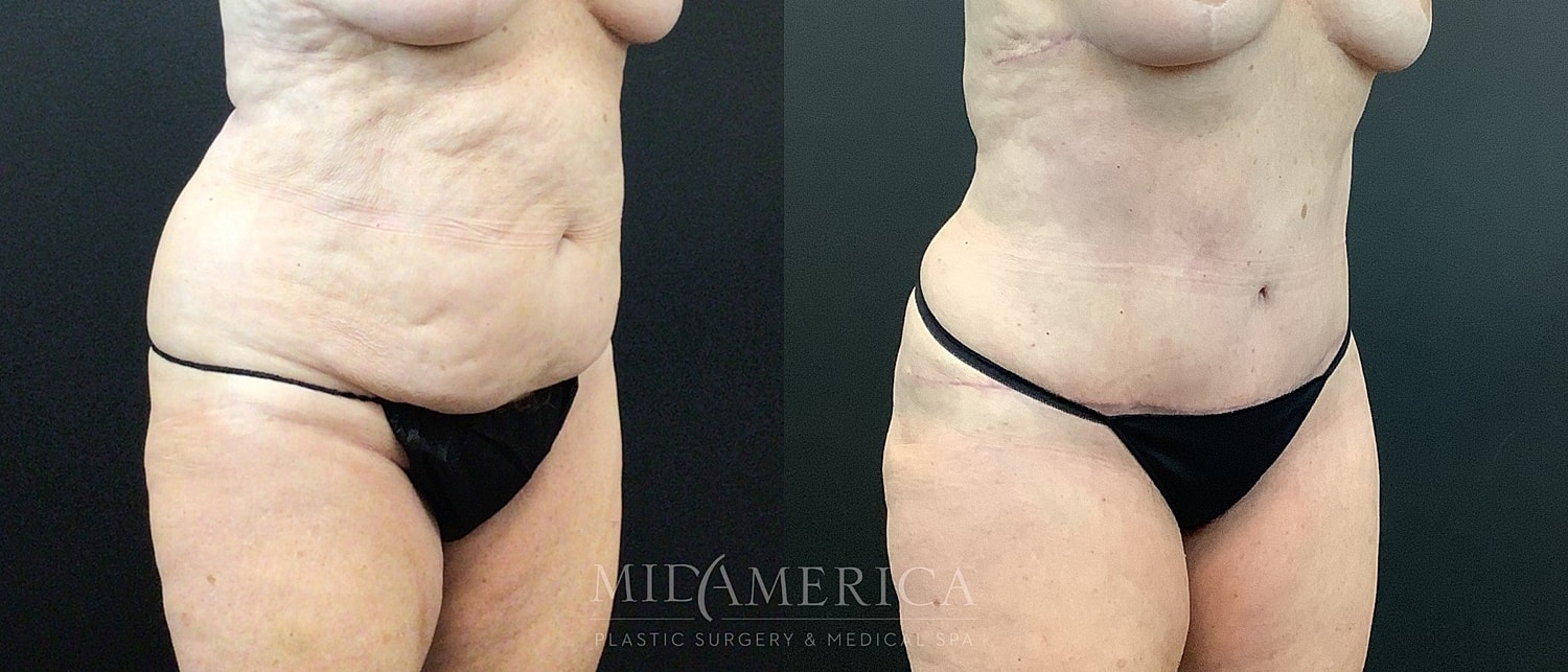 Before and after body procedure comparison image.