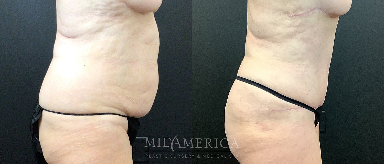 Before and after body contouring surgery.