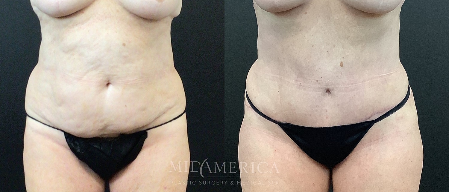 Before and after body contouring surgery.