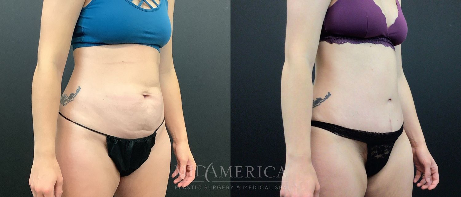 Tummy Tuck Before & After