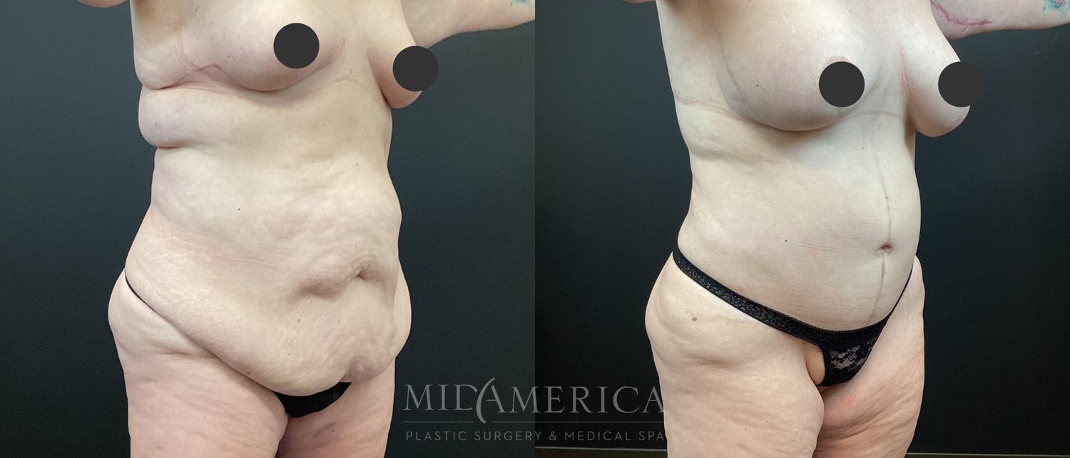 Tummy Tuck Before & After