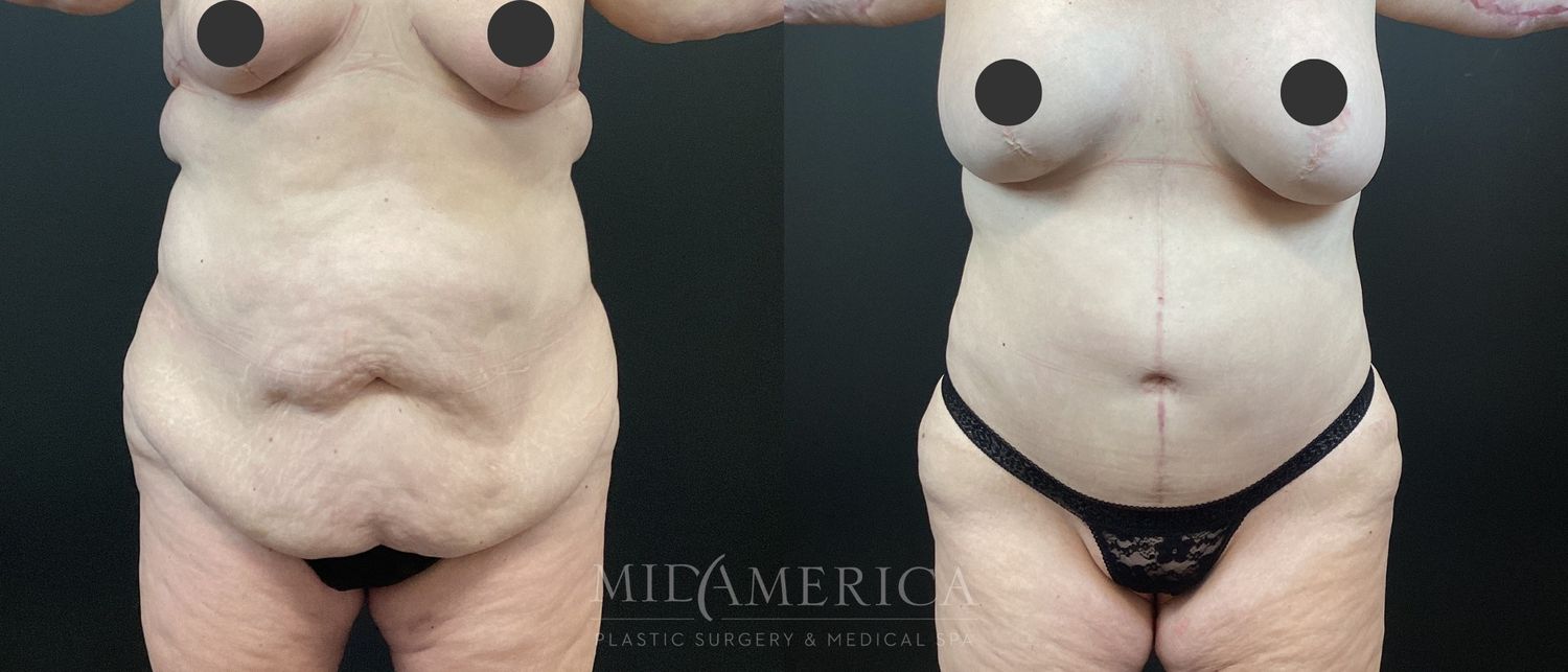Tummy Tuck Before & After