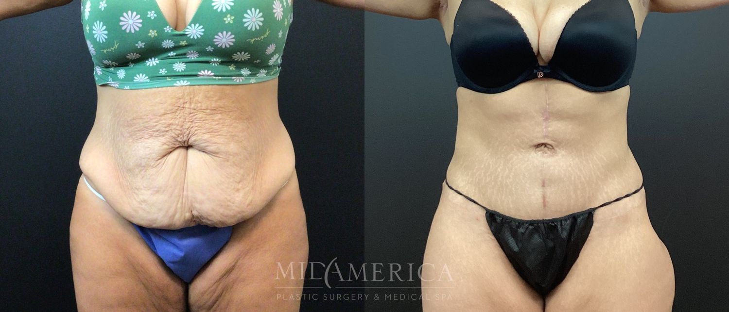 Tummy Tuck Before & After