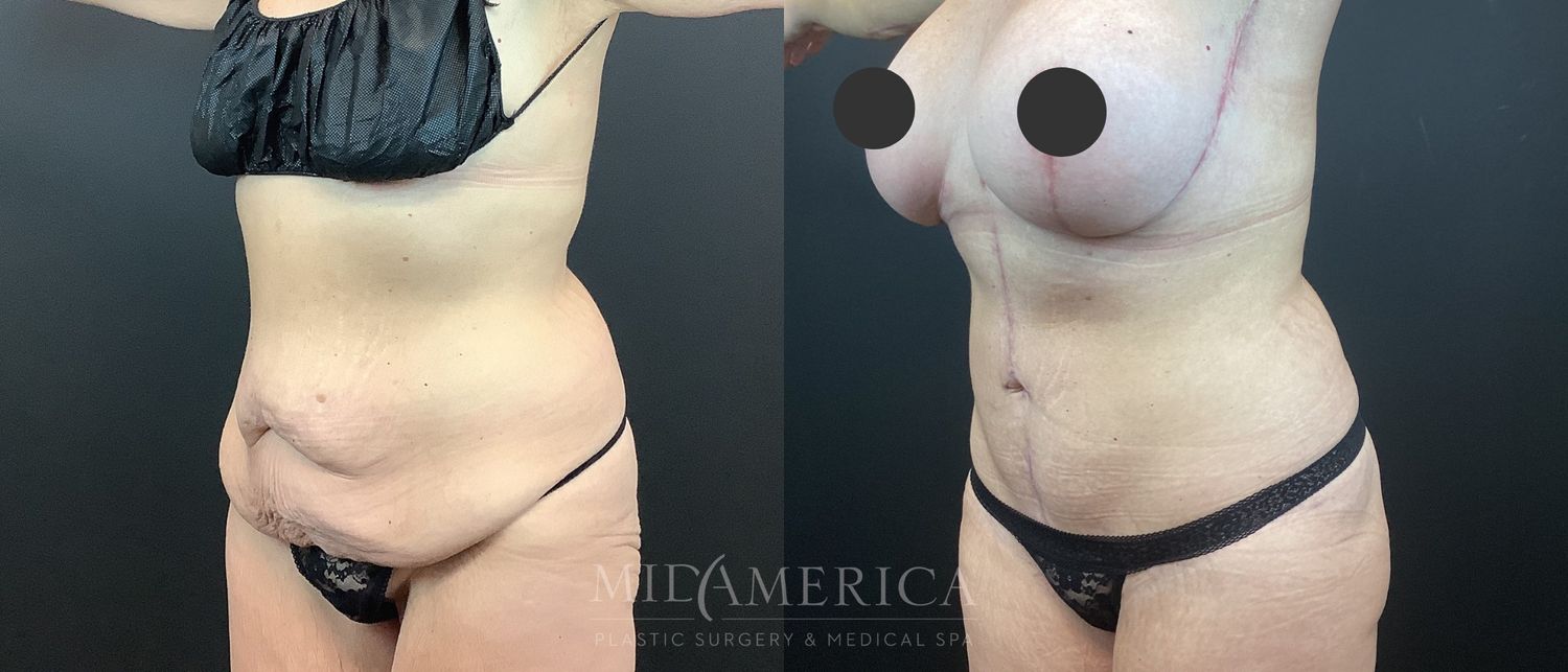 Tummy Tuck Before & After