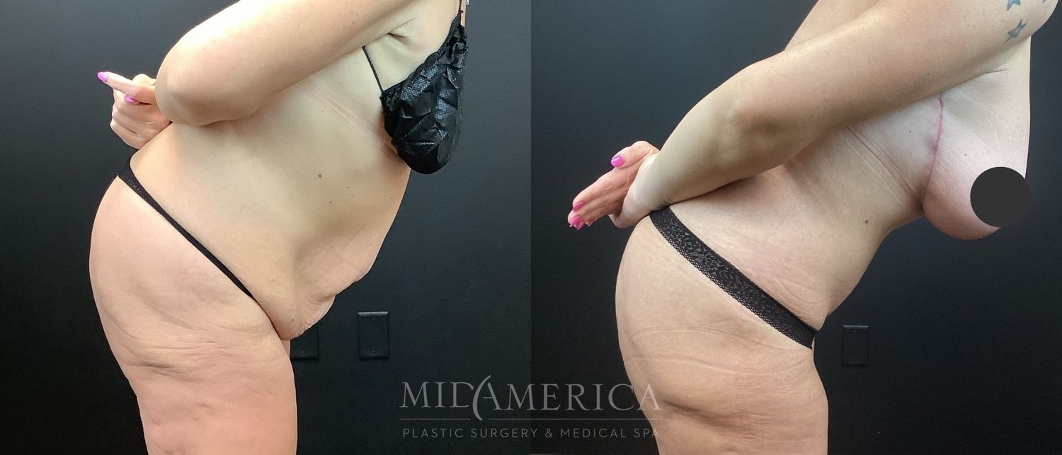 Tummy Tuck Before & After
