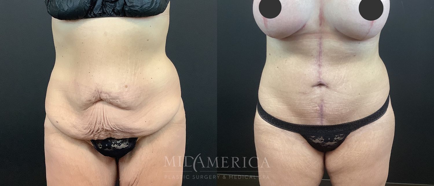 Tummy Tuck Before & After