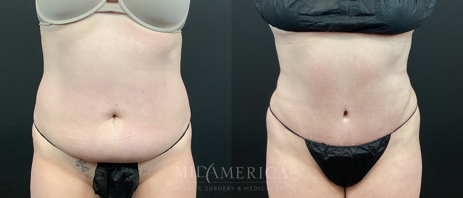 Tummy Tuck Before & After