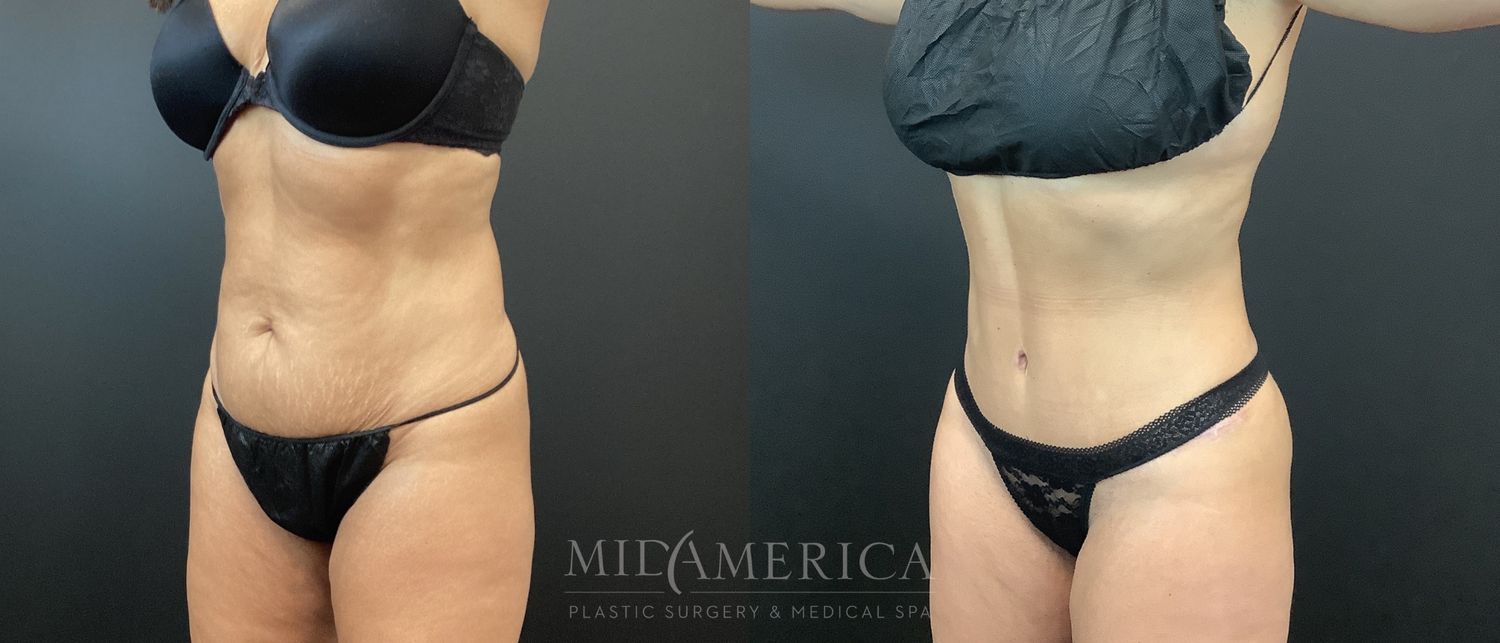 Tummy Tuck Before & After