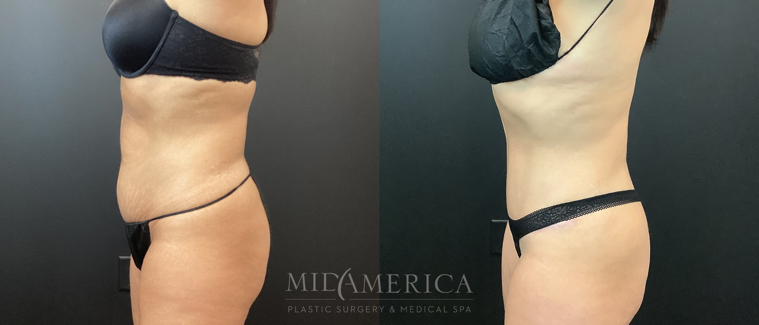 Tummy Tuck Before & After
