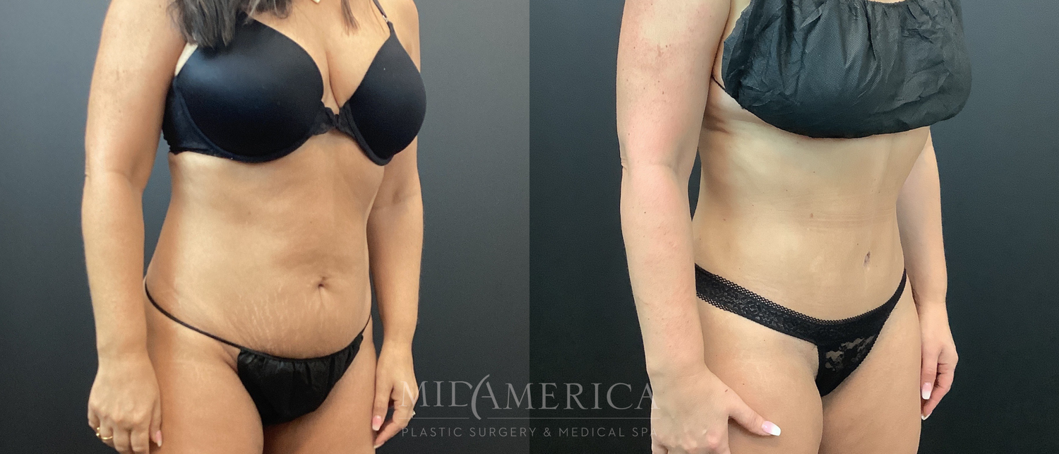 Tummy Tuck Before & After