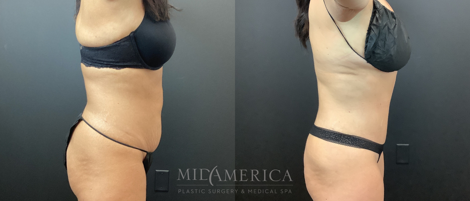Tummy Tuck Before & After