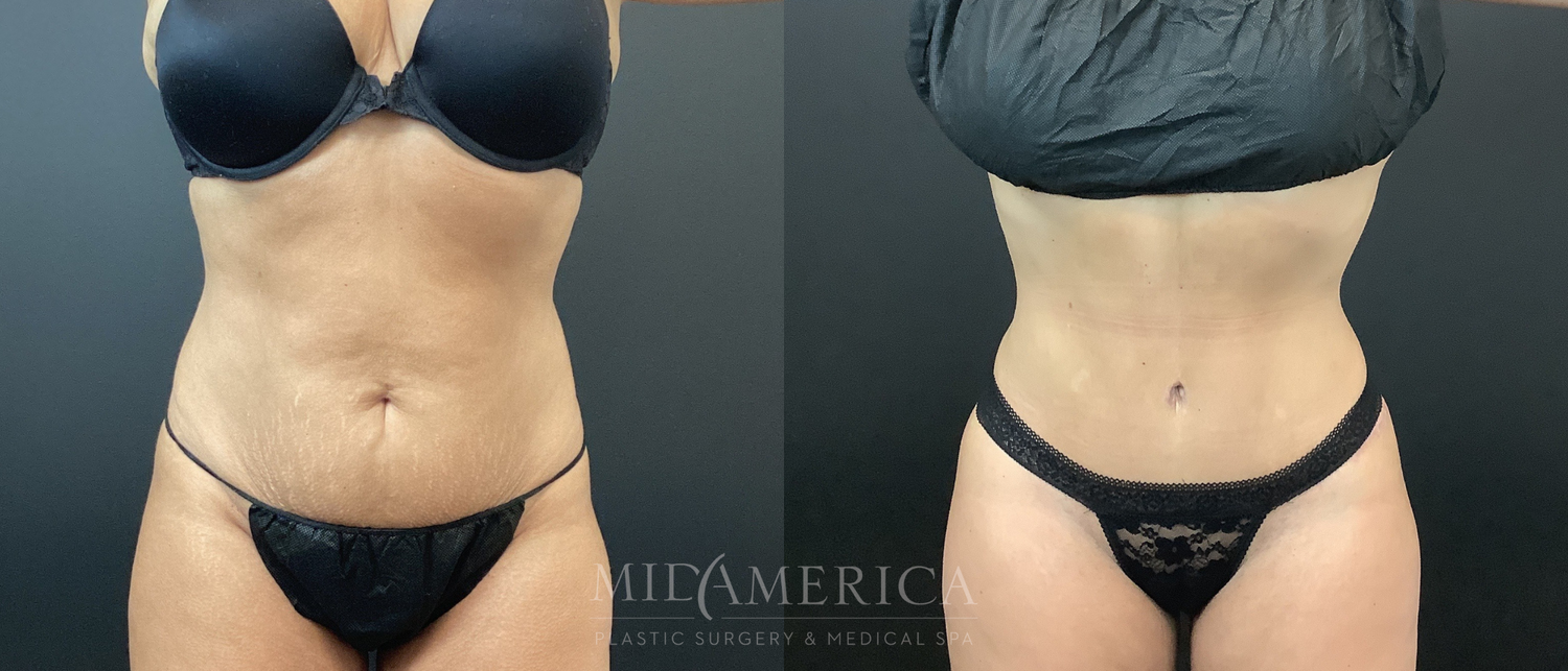 Tummy Tuck Before & After