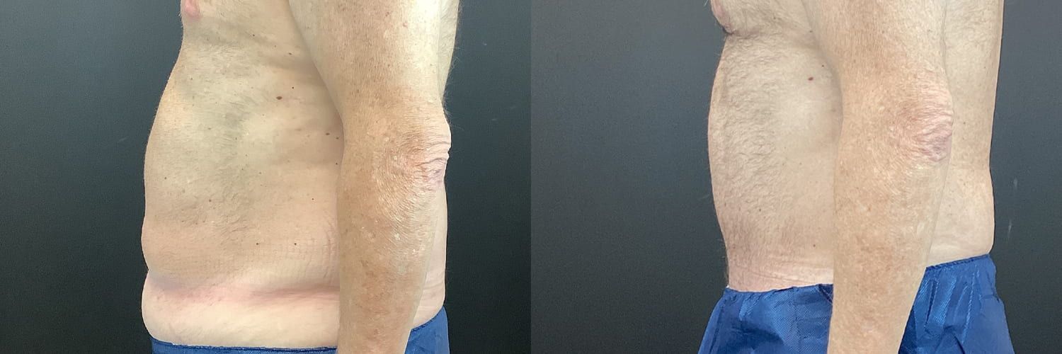 Tummy Tuck Before & After