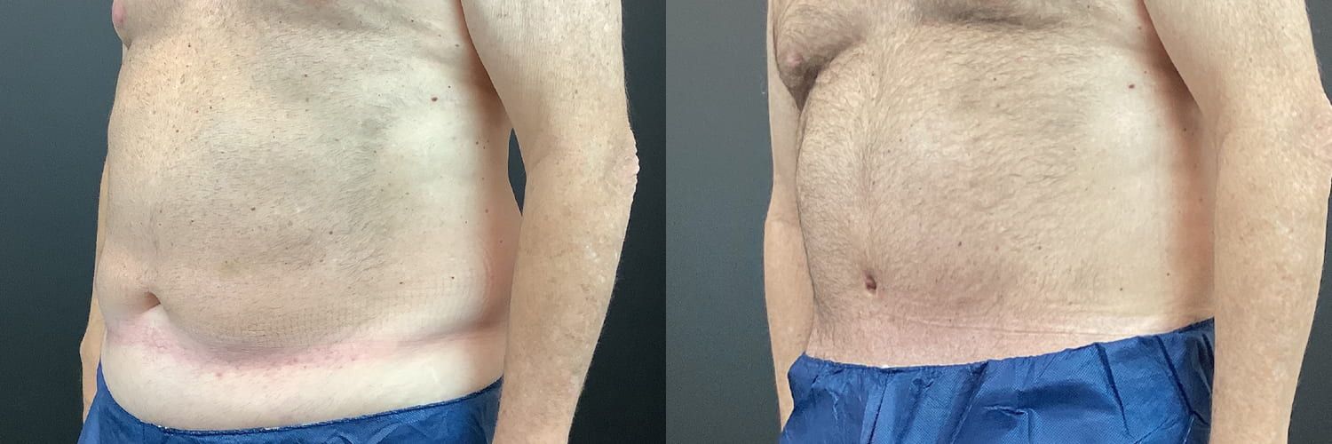 Tummy Tuck Before & After