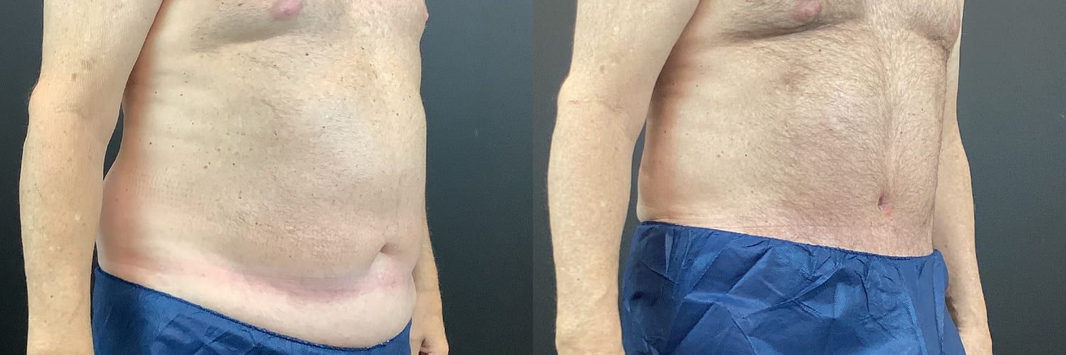 Tummy Tuck Before & After