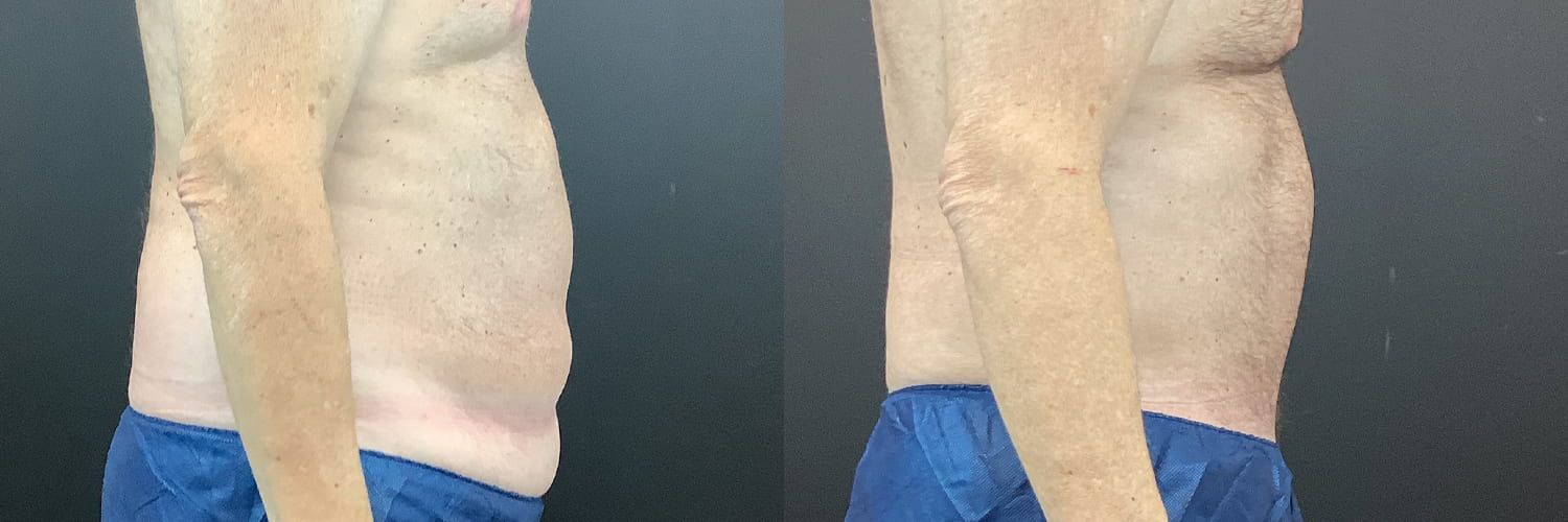 Tummy Tuck Before & After