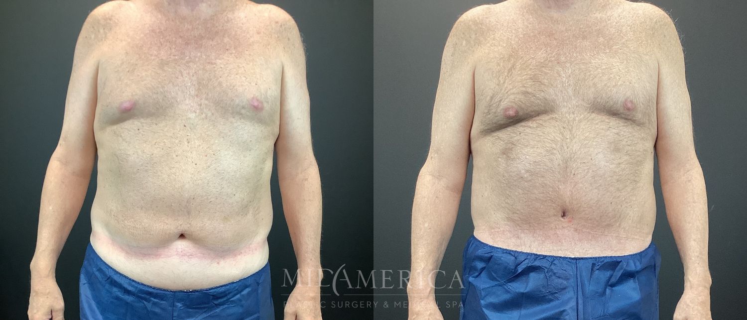 Tummy Tuck Before & After