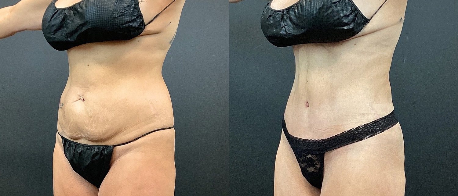Tummy Tuck Before & After