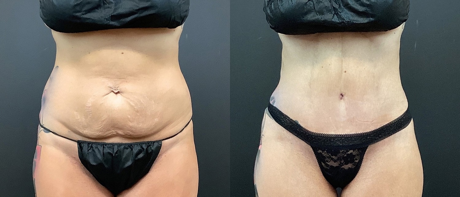 Tummy Tuck Before & After
