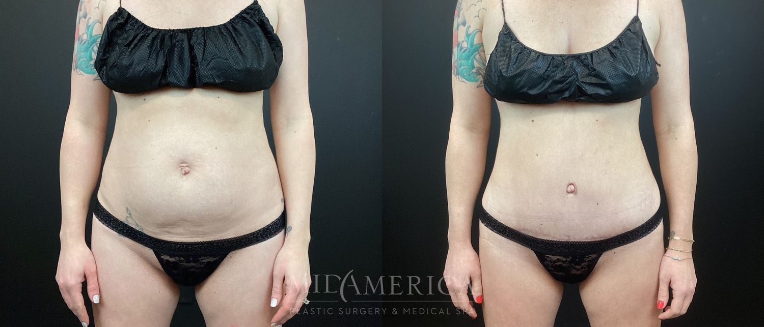 Tummy Tuck Before & After