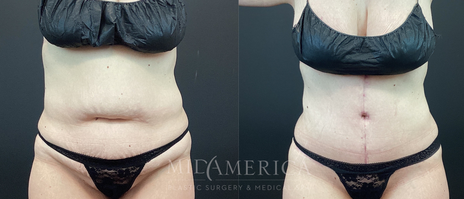 Tummy Tuck Before & After