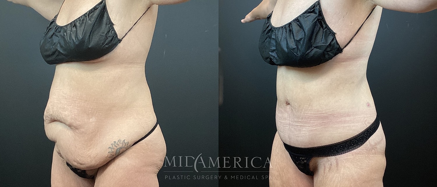 Tummy Tuck Before & After