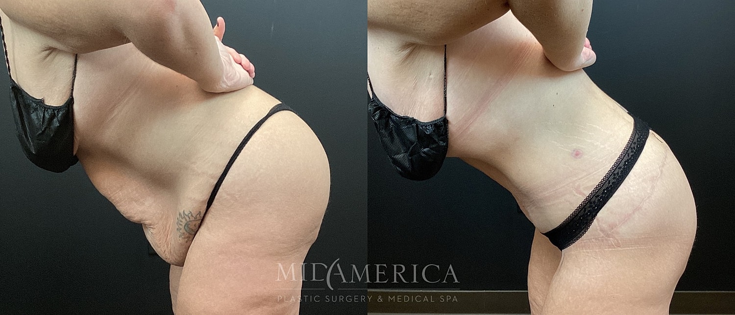 Tummy Tuck Before & After
