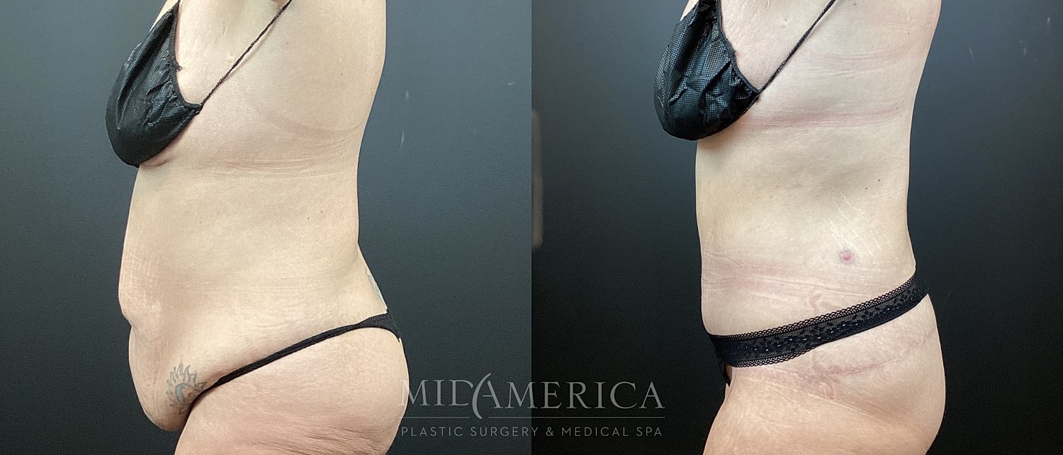Tummy Tuck Before & After