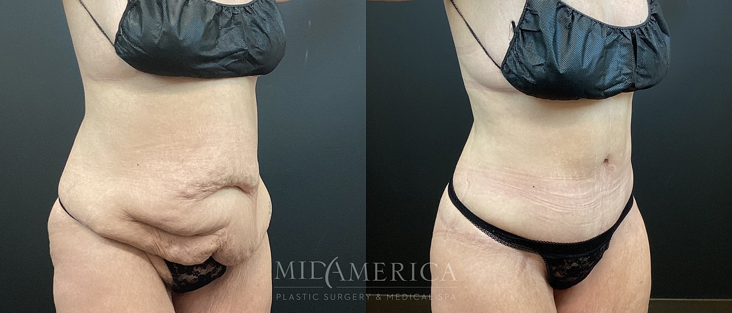 Tummy Tuck Before & After