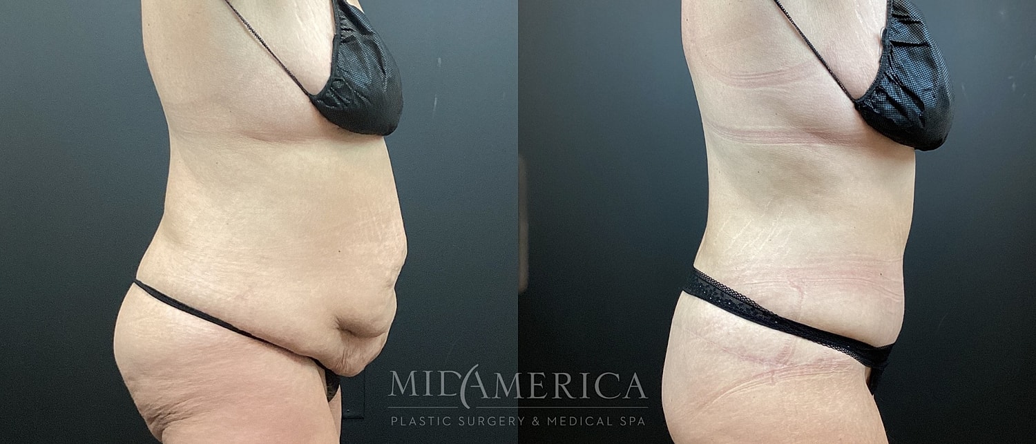 Tummy Tuck Before & After