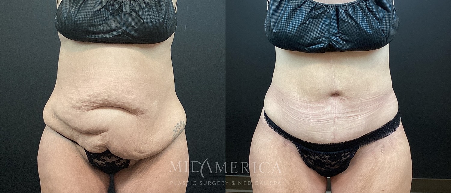 Tummy Tuck Before & After
