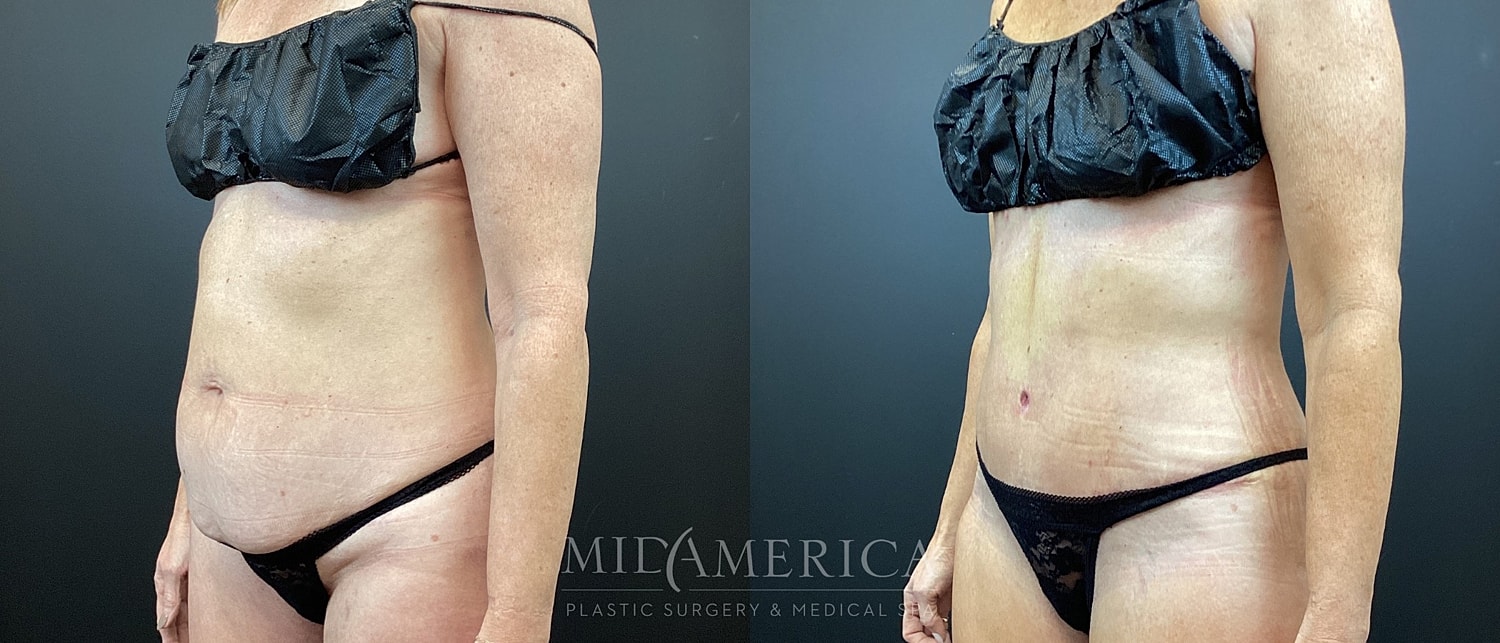 Post-operative body before and after comparison.