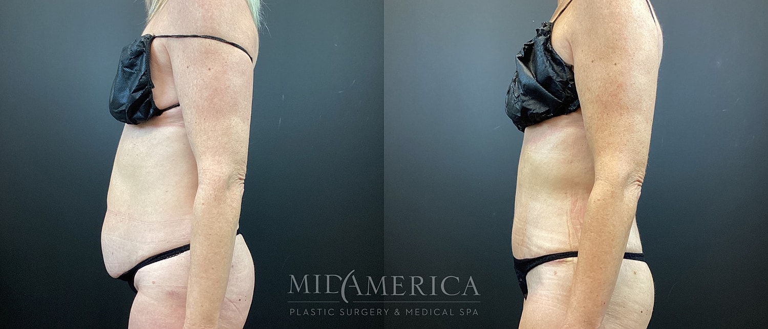 Plastic surgery before and after transformation.