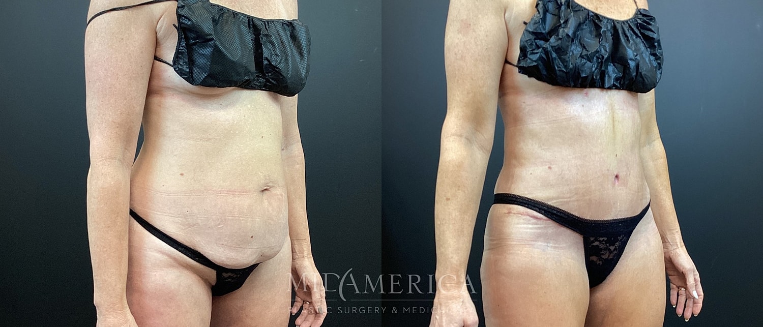 Post-surgery body transformation before and after views.