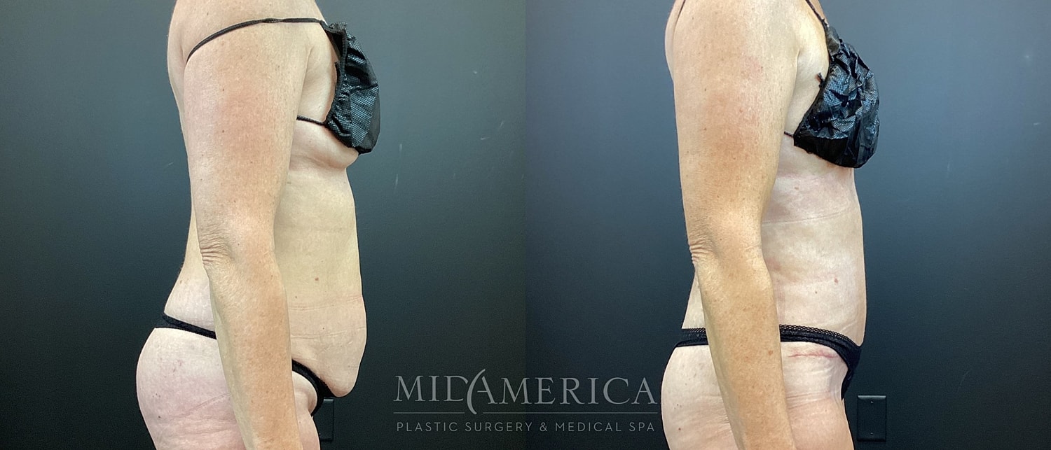 Before and after body contouring images side by side