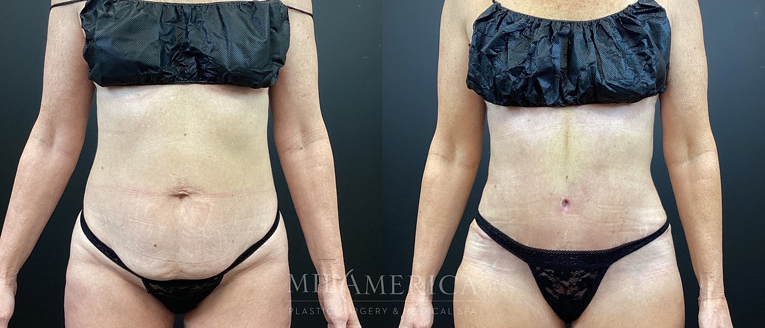 Before-and-after body contouring results.