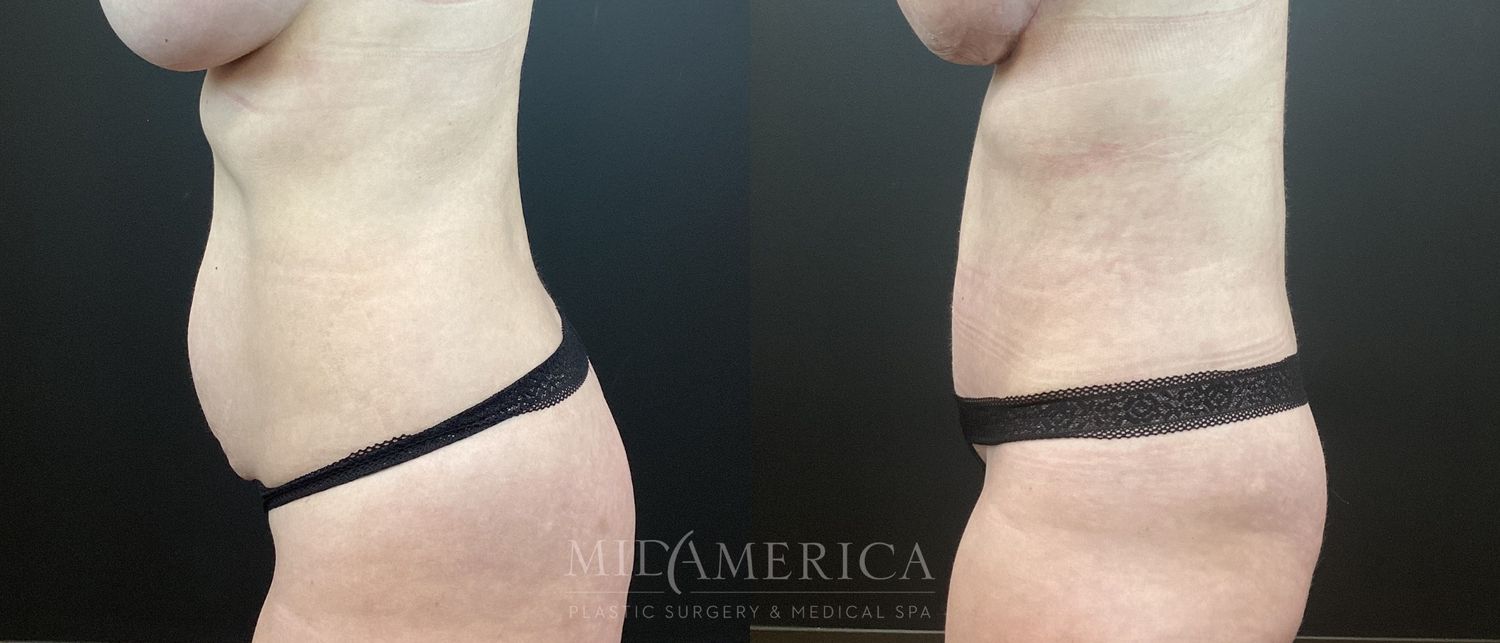 Tummy Tuck Before & After