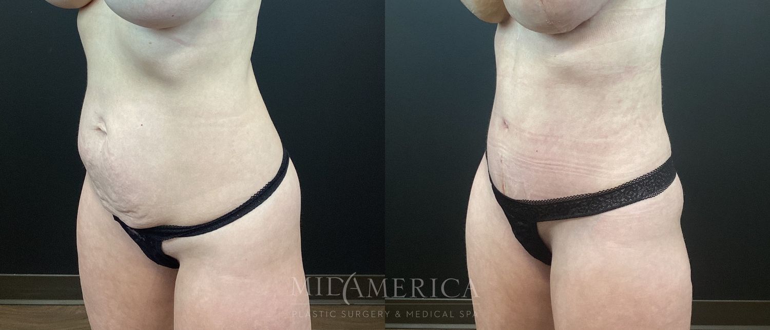 Tummy Tuck Before & After