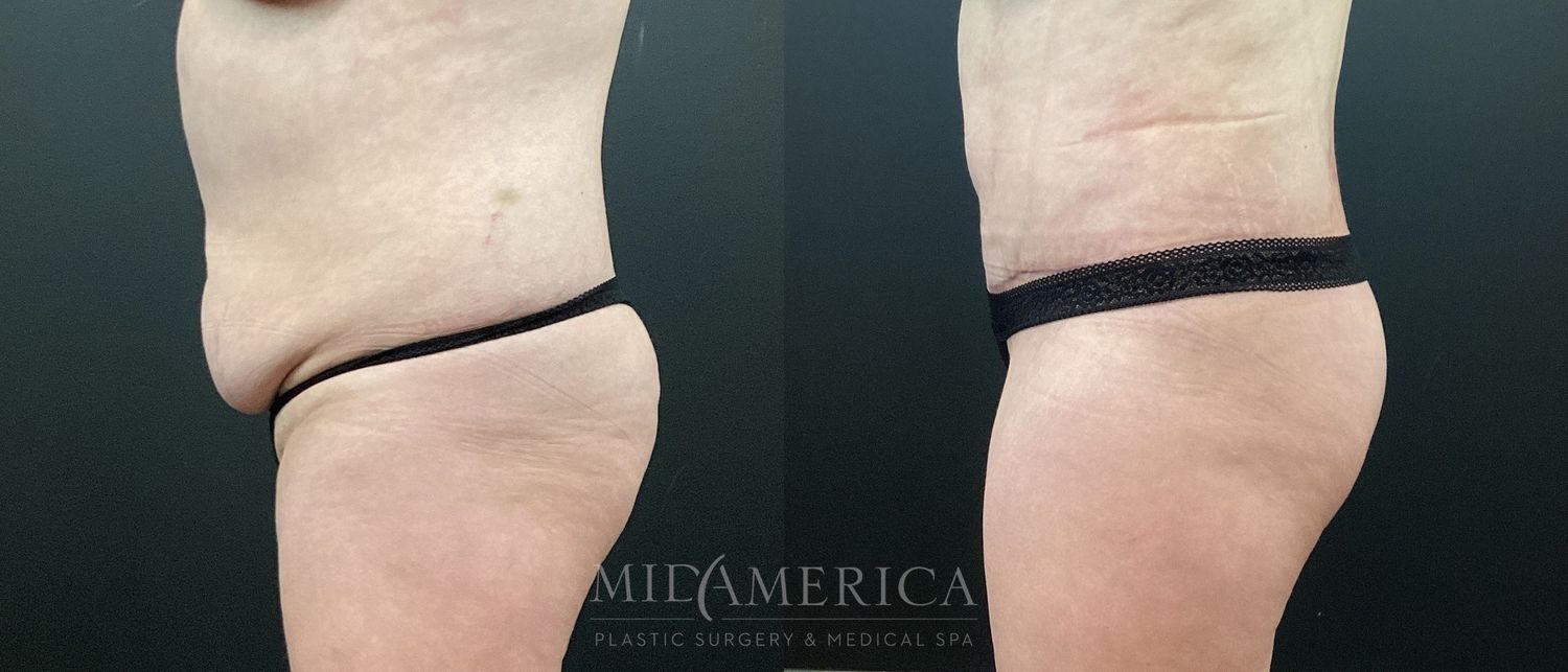 Tummy Tuck Before & After
